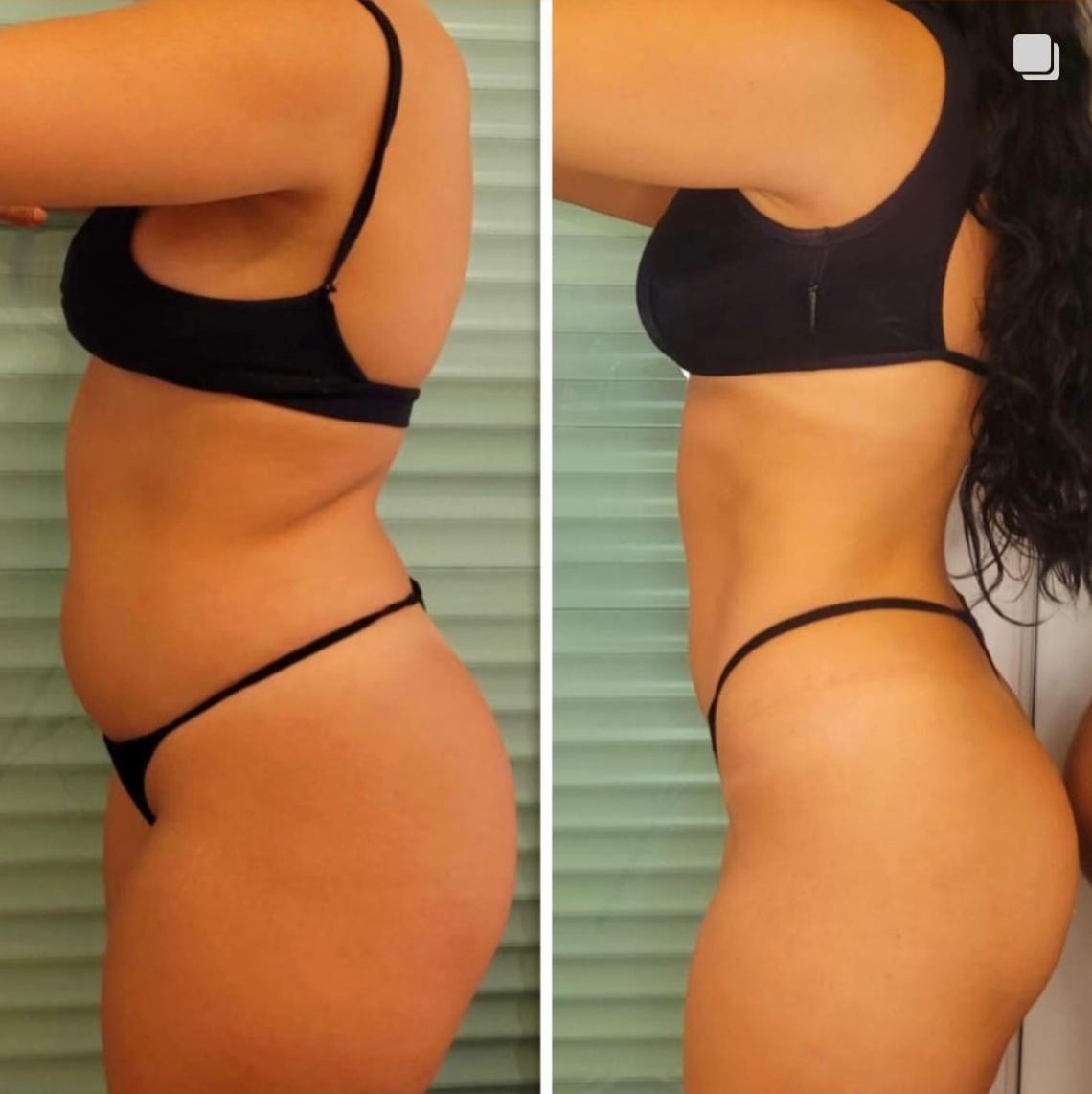 Antes e depois